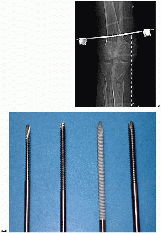 Principles of External Fixation TeachMe Orthopedics