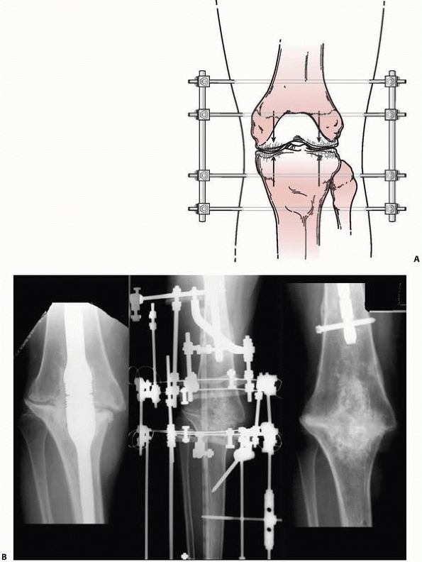 Principles Of External Fixation - TeachMe Orthopedics