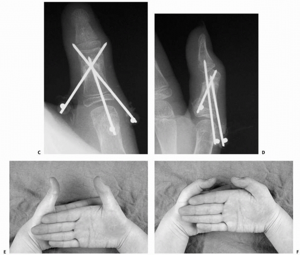 Fractures and Dislocations of The Hand and Carpus In Children - TeachMe ...