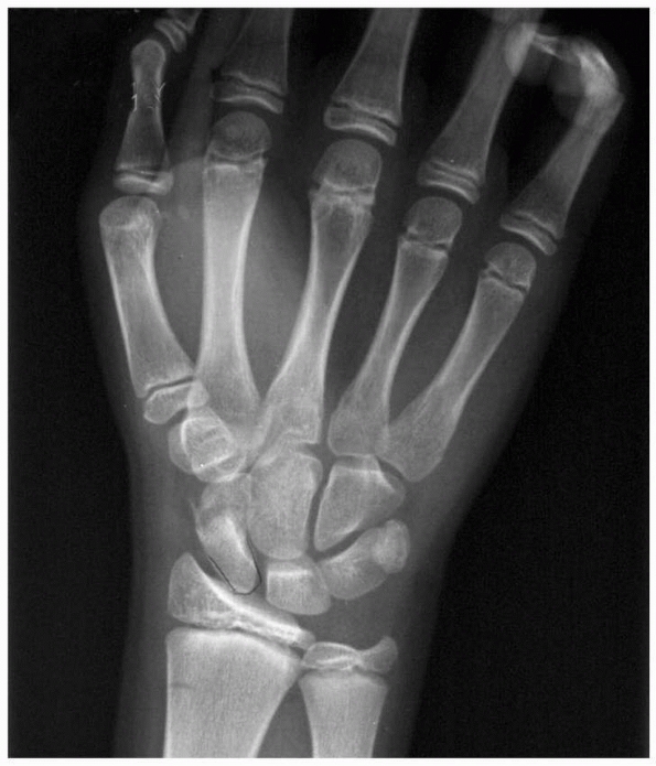 Fractures and Dislocations of The Hand and Carpus In Children - TeachMe ...