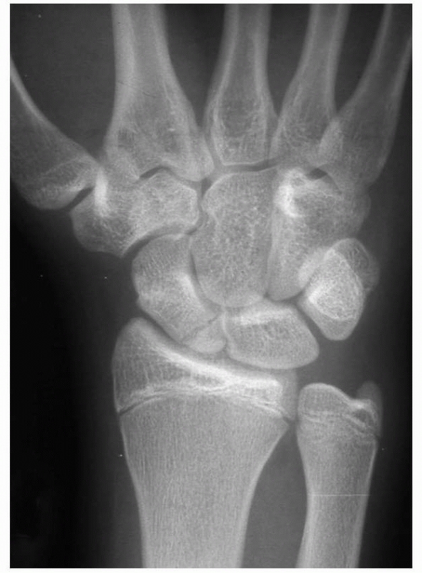 Fractures and Dislocations of The Hand and Carpus In Children - TeachMe ...