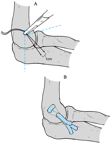 INSTABILITY AND TENDON DISORDERS OF THE ELBOW - TeachMe Orthopedics