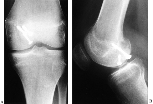 Principles Of Arthroscopy Of The Knee - Teachme Orthopedics