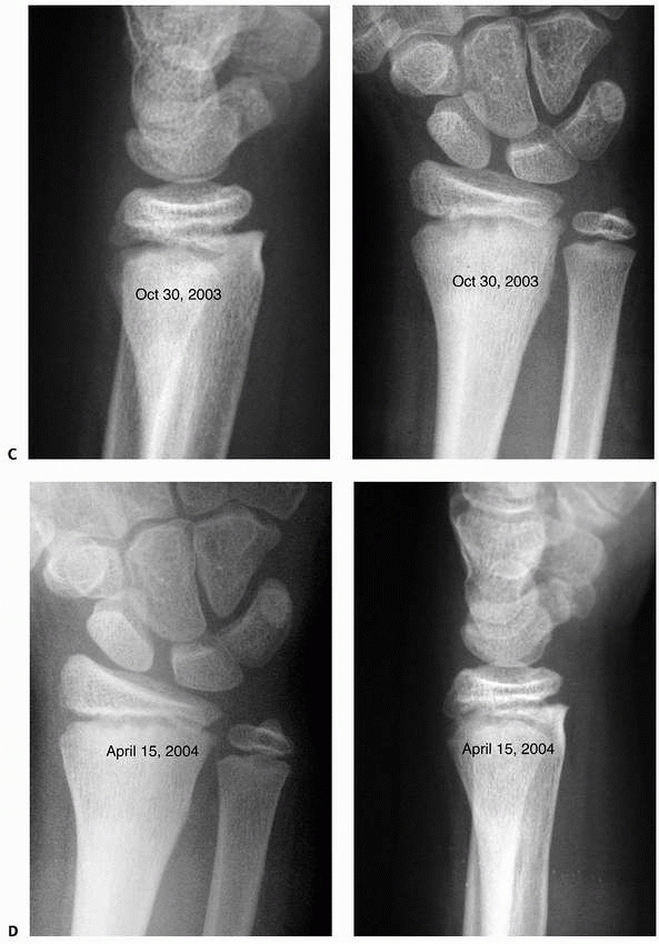 Fractures of the Distal Radius and Ulna - TeachMe Orthopedics