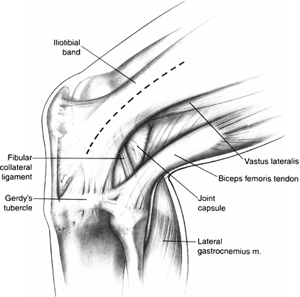 ISOLATED POSTERIOR CRUCIATE LIGAMENT INJURY AND POSTEROLATERAL LAXITY ...