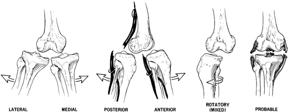 dislocations-and-multiple-ligamentous-injuries-of-the-knee-teachme