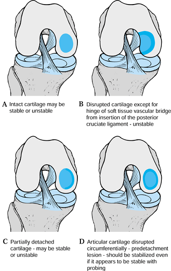 Osteonecrosis Of The Knee Knee Sports Orthobullets