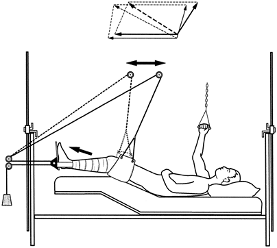 Traction - TeachMe Orthopedics