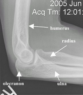 Elbow Anatomy and Examination - TeachMe Orthopedics