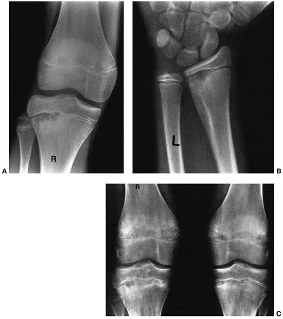 Osteomyelitis And Septic Arthritis - TeachMe Orthopedics