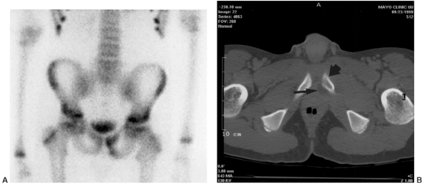 Osteomyelitis And Septic Arthritis - TeachMe Orthopedics