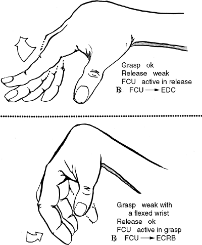 Cerebral Palsy - TeachMe Orthopedics