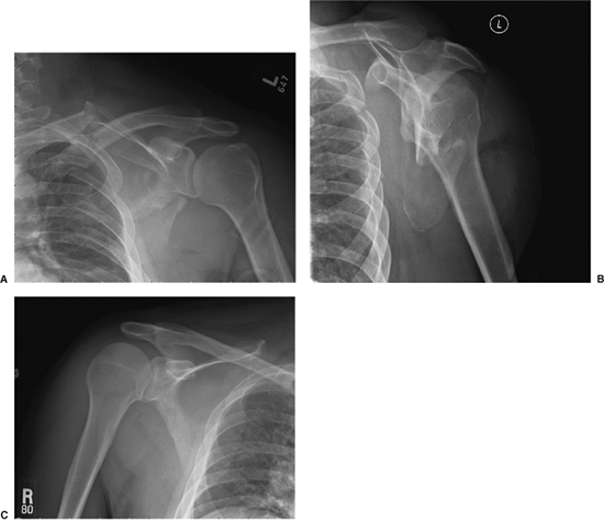 Scapula Fractures: Open Reduction Internal Fixation - TeachMe Orthopedics