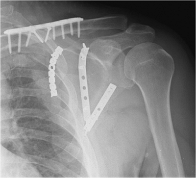 Scapula Fractures: Open Reduction Internal Fixation - TeachMe Orthopedics