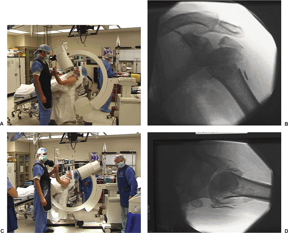 Proximal Humeral Fractures Open Reduction Internal Fixation Teachme Orthopedics