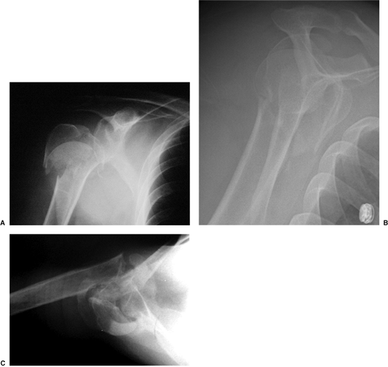 Proximal Humeral Fractures: Arthroplasty - TeachMe Orthopedics