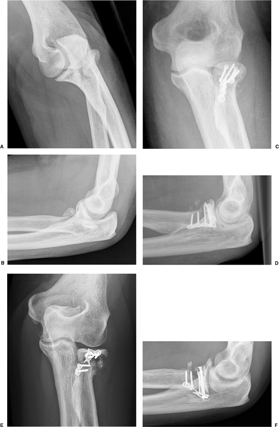 occult radial head fracture