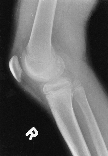 Syndromes of Orthopaedic Importance - TeachMe Orthopedics