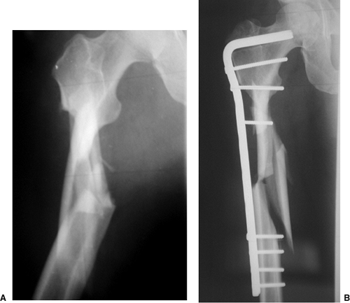 Subtrochanteric Femur Fractures Plate Fixation Teachme Orthopedics My