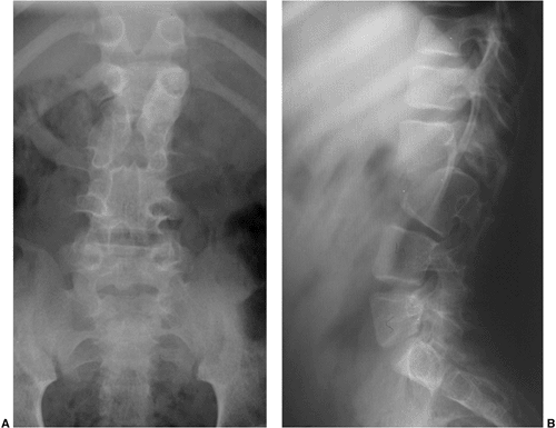 Kyphosis - TeachMe Orthopedics