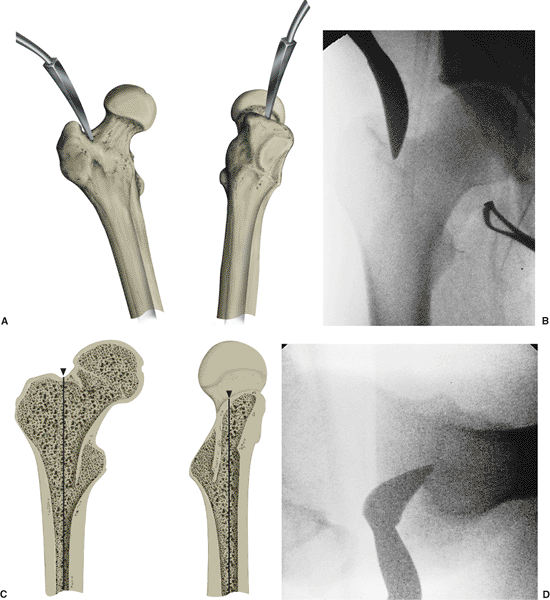 Femur Fractures: Antegrade Intramedullary Nailing - TeachMe Orthopedics