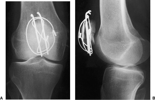 Patellar Fractures: Open Reduction Internal Fixation - TeachMe Orthopedics