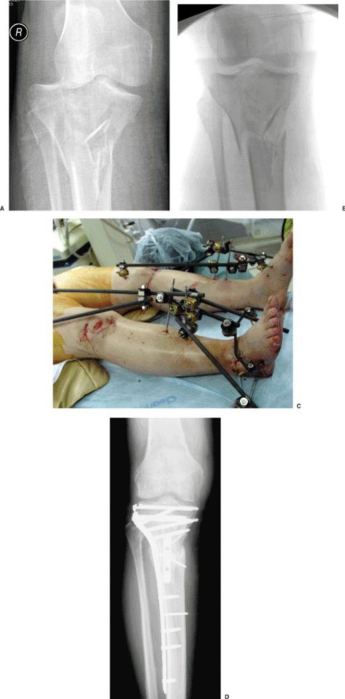 Tibial Plateau Fractures: Open Reduction Internal Fixation - TeachMe ...