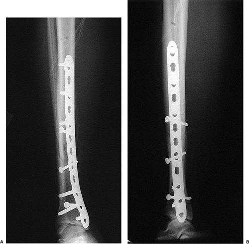 Tibial Shaft Fractures: Open Reduction Internal Fixation - TeachMe ...