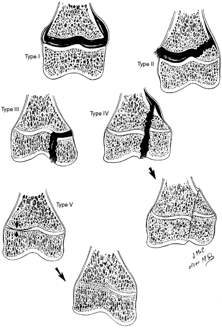 Leg-Length Discrepancy - TeachMe Orthopedics