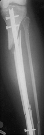 Tibial Shaft Fractures: Intramedullary Nailing - TeachMe Orthopedics