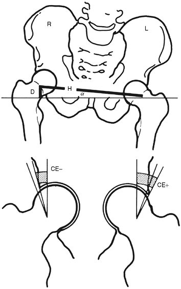 Leg-Length Discrepancy - TeachMe Orthopedics