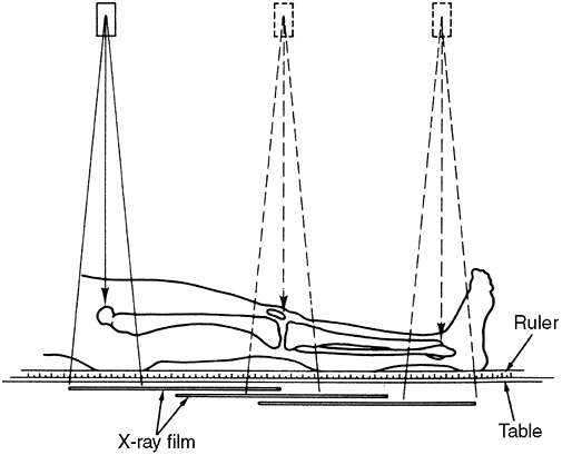 Leg-Length Discrepancy - TeachMe Orthopedics