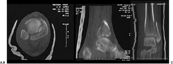 Tibial Pilon Fractures: Open Reduction Internal Fixation - TeachMe ...