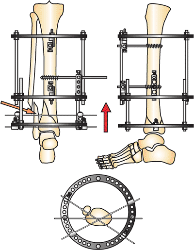 The Treatment of Distal Tibia Peri-articular Fractures with Circular ...