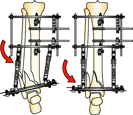 The Treatment of Distal Tibia Peri-articular Fractures with Circular ...