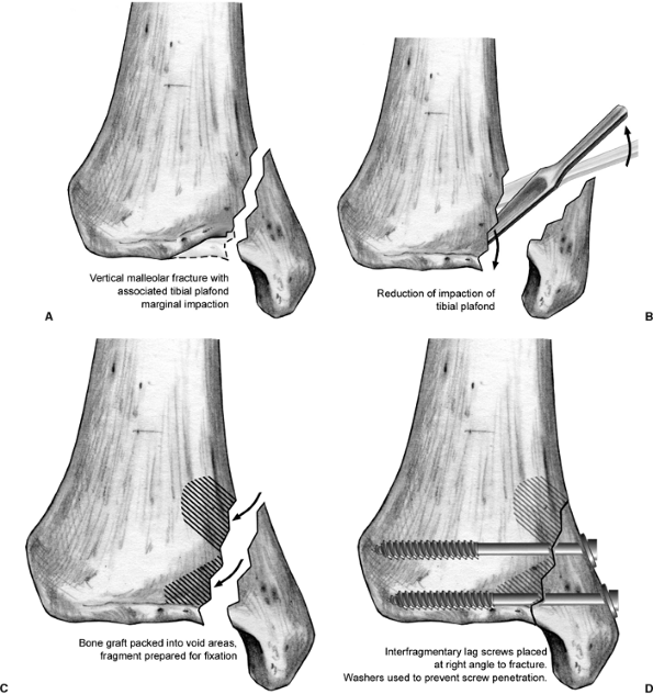 ankle surgery open reduction internal fixation