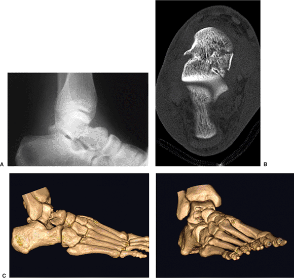 Talus Fractures: Open Reduction Internal Fixation - TeachMe Orthopedics