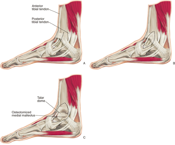 Talus Fractures: Open Reduction Internal Fixation - TeachMe Orthopedics