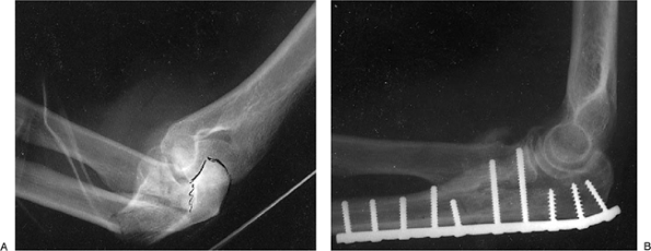 Management of Olecranon Fractures and Nonunion - TeachMe Orthopedics