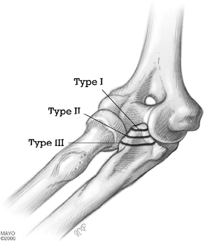 Fractures of the Coronoid and Complex Instability of the Elbow ...