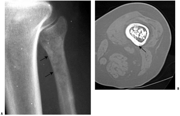 Cartilage Lesions - TeachMe Orthopedics