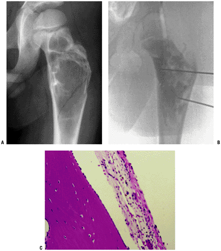 Cystic Lesions - TeachMe Orthopedics