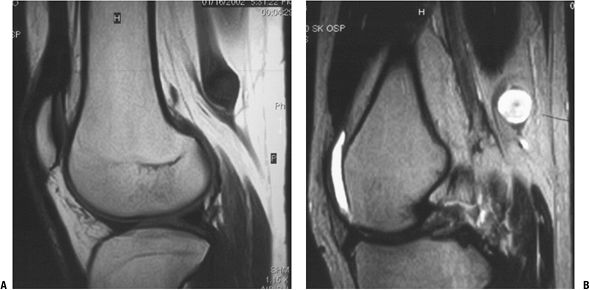 Benign Soft Tissue Tumors - TeachMe Orthopedics