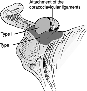 Scapula Fractures - TeachMe Orthopedics