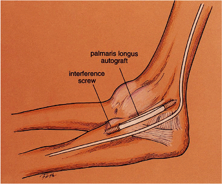 Treatment of Ulnar Collateral Ligament Injuries in Athletes - TeachMe ...