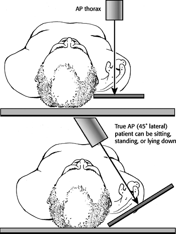 Glenohumeral Dislocation - TeachMe Orthopedics