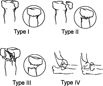 Radial Head - TeachMe Orthopedics