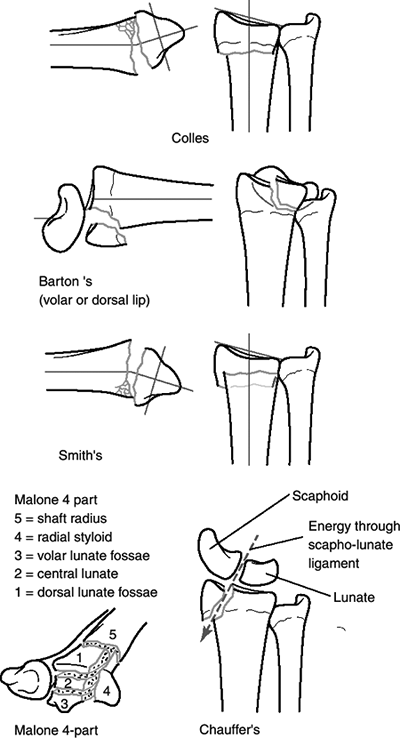 Distal Radius - TeachMe Orthopedics
