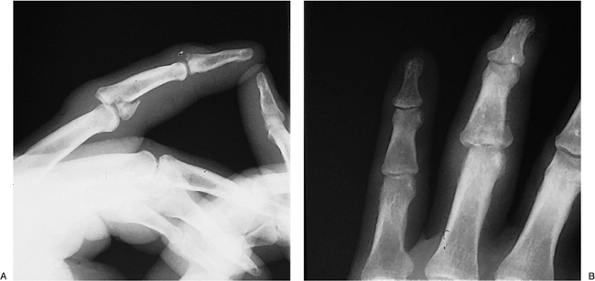 Hand Fractures Fracture-Dislocations - TeachMe Orthopedics