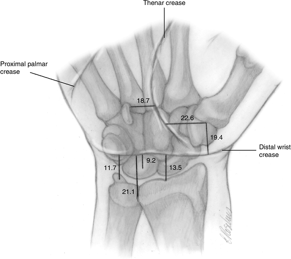 Carpal Fractures - TeachMe Orthopedics